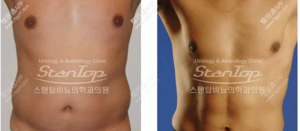 　360º多维立体男性腹部吸脂——
精确定位，无需运动，
体型塑造，永久科学健康块腹肌，

360º多维立体男性腹部吸脂术
    男性腹部吸脂一次一般能抽取800-4000ml的脂肪来改善男人的小肚腩，腹部吸脂手术(抽脂手术)直截作用于腹部脂肪，将脂肪转化称为脂肪液，然后吸出体外，使得腹部脂肪变的很薄，进而来改善腰围，去除小肚子。腹部吸脂让男人轻松减腹腰腹选择在做腹部吸脂，吸脂后不须要住院，第二天变可以上班，不影响工作，让繁忙的男人们不必担心留守医院，轻松减腹。男人经过做腰腹部吸脂减肥(吸脂塑身)不仅可以改善腰腹堆积的脂肪，而且可以减少由于腰腹部脂肪堆积而引起的一些疾病。