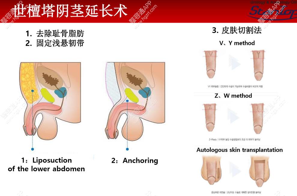 阴茎延长术