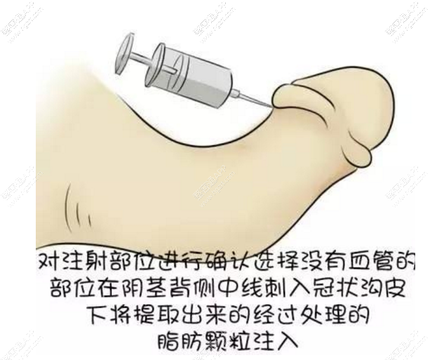 韩国试探他阴茎增粗手术方法：透明质酸玻尿酸成分增粗、人体真皮粉末玻尿酸成分增粗