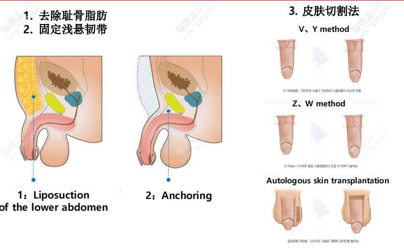 试探他阴茎延长术：①去除耻骨脂肪