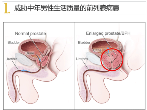 慢性前列腺炎是男性成人常见疾病