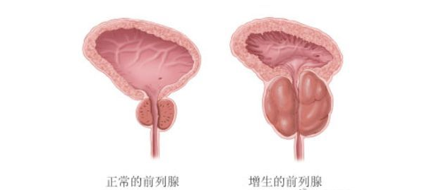 前列腺增生不可盲目长期用药