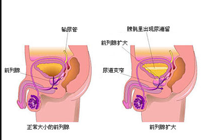 虽然前列腺增生和前列腺癌的临床表现症状比较相似