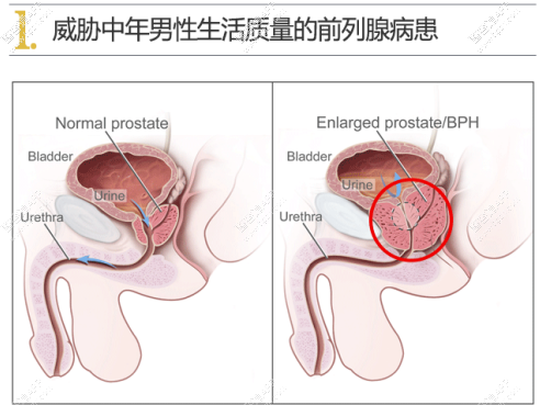 Q：不幸患上了慢性前列腺炎