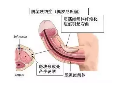 体外冲击波治疗阴茎勃起障碍有没有科学依据？今天试探他男科专门针对体外冲击波治疗阴茎勃起障碍等相关问题给大家做一个解答