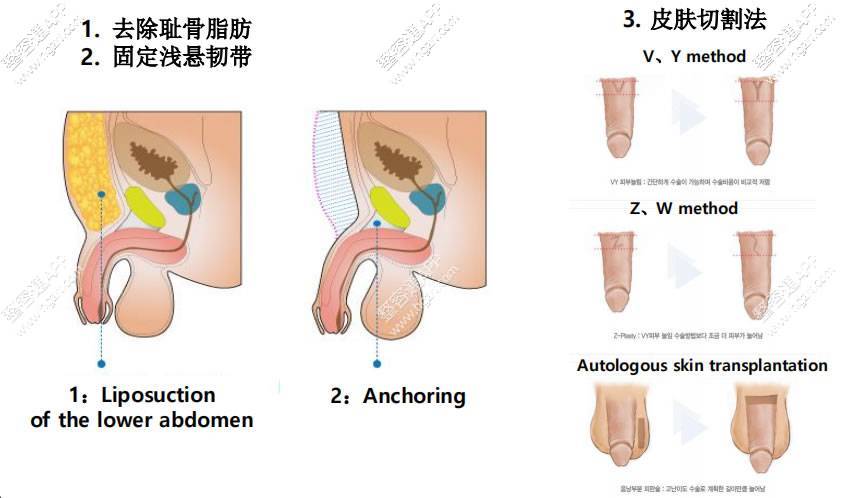 韩国试探他阴茎延长术：皮肤切割法