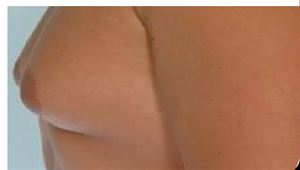 　什么是「男性女乳症」？如何诊断？
很简单，只要是男性的胸部但是看起来像女性的乳房就可以叫男性女乳症，
或用食指与拇指掐起乳晕部位，若皮肤厚度超过两公分或比腋下皮肤厚，就有可能得了男性女乳症（Gynecomastia）。