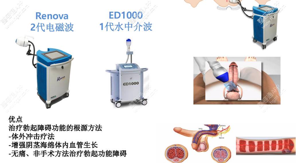 已经阳痿的患者怎么治疗呢？目前对于中轻度的阳痿患者比较有效的方法是体外冲击波治疗