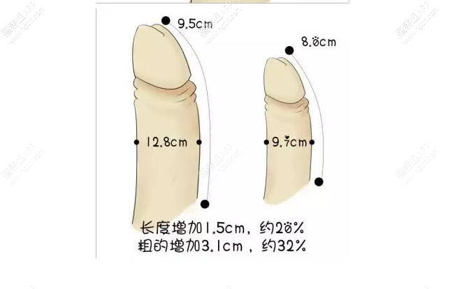 2、单纯脂肪注射阴茎成形术：这种手术方法是抽取自身的脂肪