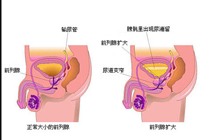 男性前列腺炎的危害