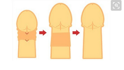 　阴茎延长术的医学原理　阴茎延长术的医学原理，从适当位置切断阴茎上的浅悬韧带和深悬韧带，可以使埋藏在会阴的那段阴茎海绵体分离出来，其体外部分即能因此而延长3～5厘米，再用阴囊上端皮肤或邻近皮瓣覆盖被分离出来的海绵体的创面，使缺损的阴茎可延长3～5厘米。