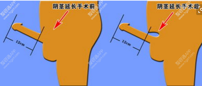 　阴茎延长术的适应人群有：
　　一、根据阴道解剖和女性生理特征及中国成年男性阴茎正常长度测量，常态下为7.1±1.5cm，勃起时为13.0±1.3cm。若阴茎发育不良，勃起时长度不足10cm，且不满足女方性要求者，可做阴茎延长术。
　　二、小阴茎勃起时，其长度和周径在5～8cm之间，睾丸体积大于6ml时，在做阴茎加粗术的同时做阴茎延长术，有利于阴茎的形态接近正常。