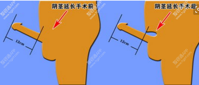 　阴茎延长术的适应人群有：
　　一、根据阴道解剖和女性生理特征及中国成年男性阴茎正常长度测量，常态下为7.1±1.5cm，勃起时为13.0±1.3cm。若阴茎发育不良，勃起时长度不足10cm，且不满足女方性要求者，可做阴茎延长术。
　　二、小阴茎勃起时，其长度和周径在5～8cm之间，睾丸体积大于6ml时，在做阴茎加粗术的同时做阴茎延长术，有利于阴茎的形态接近正常。