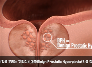 无创前列腺肥大环缩小手术是韩国试探他男科医院独创的前列腺治疗手术