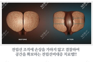无创前列腺肥大环缩小手术是韩国试探他男科医院独创的前列腺治疗手术
