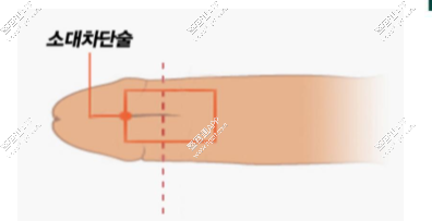 阴茎系带切除技术：由敏感性龟头引起的早泄的治疗方法