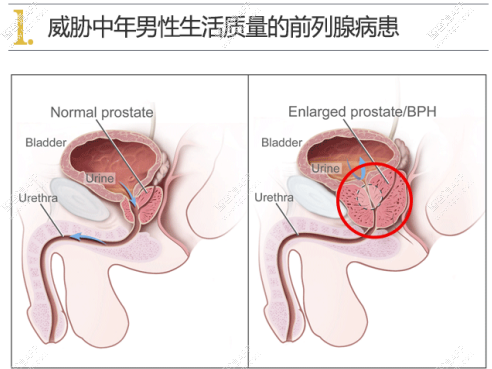 前列腺钙化跟前列腺结石的区别