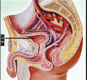 前列腺钙化斑是什么