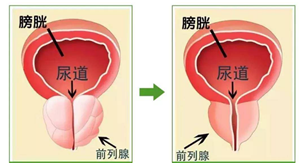 如果前列腺钙化引起排尿困难的情况