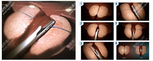 前列腺肥大环缩手术是韩国试探他男科医院独创的前列腺治疗手术