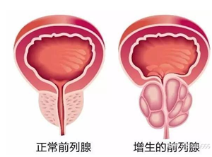 前列腺电切术是经尿道前列腺电切术