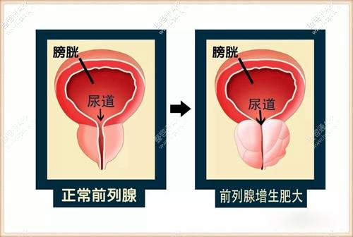 韩国试探他前列腺肥大微创技术