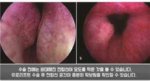 增生的腺体对人体无害