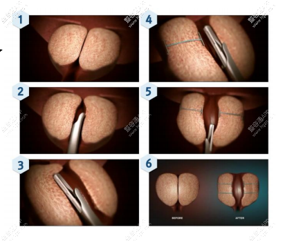 前列腺肥大环缩手术是韩国试探他男科医院独创的前列腺治疗手术