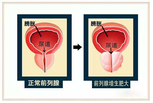 当肥大后就会压迫膀胱造成小便不顺