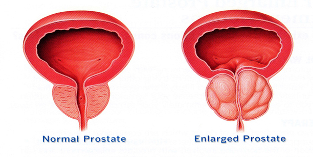 孙医师：前列腺的特殊位置和结构决定了单纯的药物治疗