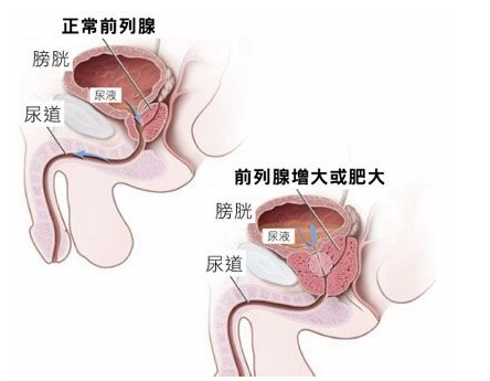 　前列腺肥大又称前列腺增生，在我国前列腺肥大的发病率呈上升趋势，且多发于老年男性，患者常伴有尿频、尿急等症状，对患者的生活造成了严重的影响。那么，前列腺肥大会带来哪些危害呢?

　　