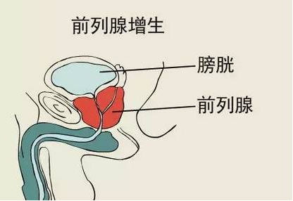 　三、导致一系列不适症状

　　前列腺发生肥大后临近前列腺的膀胱首当其冲，由于尿液排出受阻，膀胱必须用更大的力量才能将尿液通过变窄的尿道排出，因此，膀胱壁的逼尿肌代偿性增厚，这时，虽然尿液尚能完全排出，但患者开始出现尿频、尿急，尤其夜尿增多的症状。