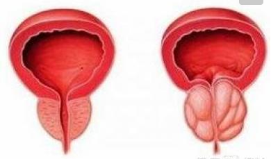 人们平常说的前列腺增生症属良性病变