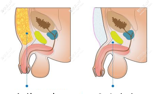 阴茎延长术:通过去除耻骨脂肪